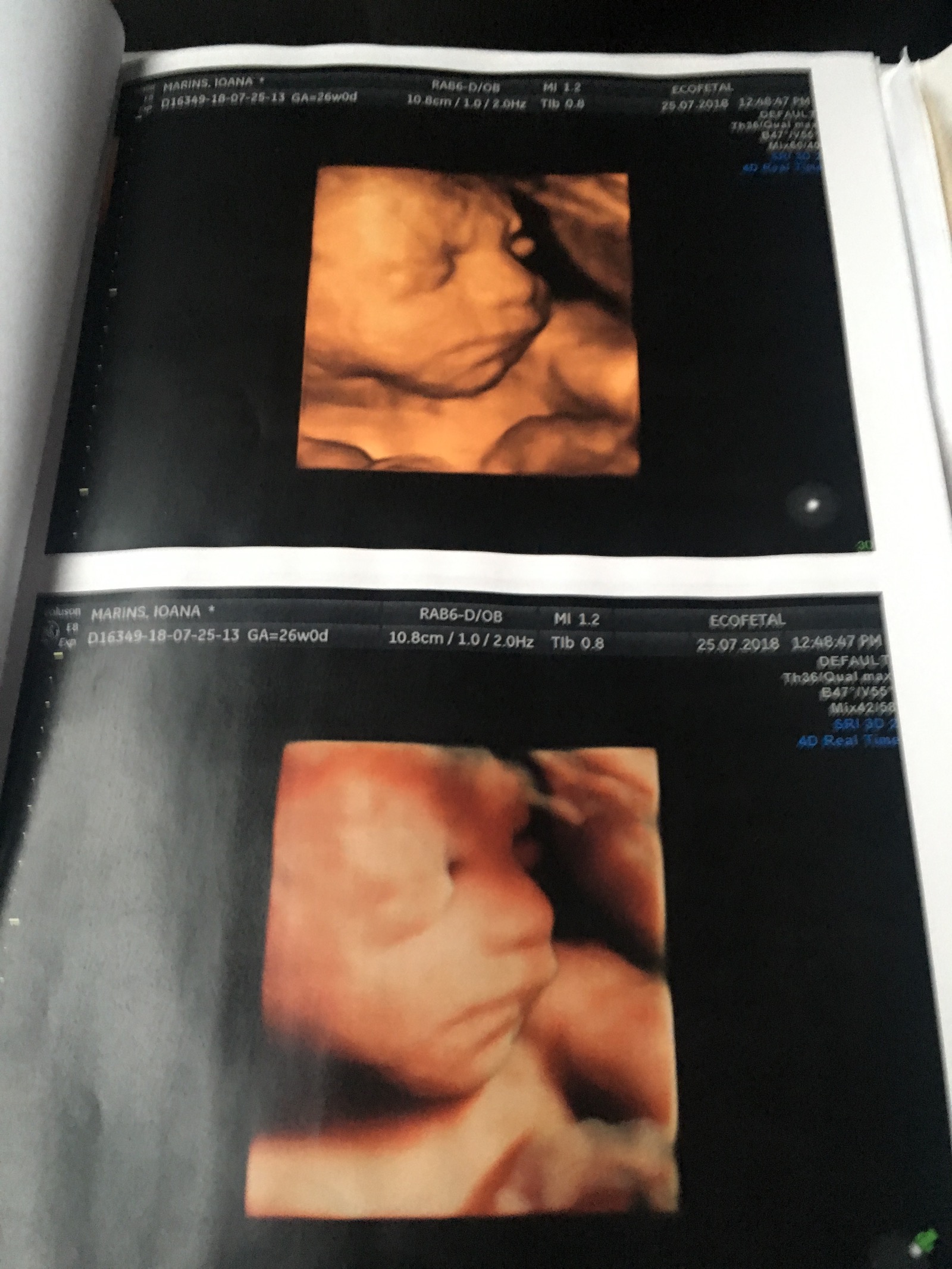 Luca's scan with 6 months, Brazil